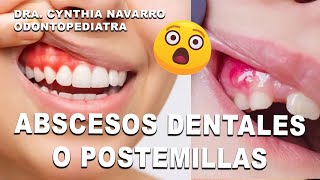 🤔😩 ¿Por qué salen abscesos o postemillas en la boca [upl. by Idnyc18]