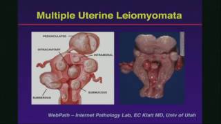 Ultrasound of the Uterus and Endometrium [upl. by Adnerad]