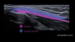 Triceps rupture ultrasound [upl. by Sherline]