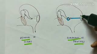 otosclerosis  ENT  etiology  pathophysiology  clinical manifestations  treatment  English [upl. by Follansbee349]