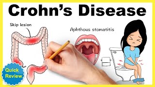 Crohns disease Symptoms pathophysiology diagnosis treatment mnemonic Quick review [upl. by Yortal941]