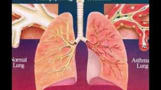 Pathophysiology of asthma [upl. by Atived]