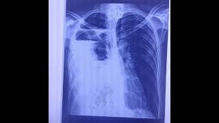 xray lungs Hydropneumothorax pleura effusionpneumothorax [upl. by Naimad]