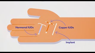 IUDs for Contraception [upl. by Mcnair593]