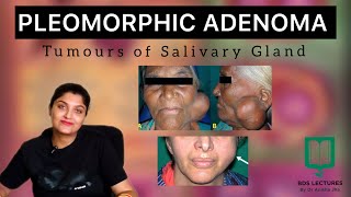 Pleomorphic Adenoma  Lecture 38  Salivary Gland Tumours  BDS  MDS  NEET MDS  Dental  Medical [upl. by Velvet]