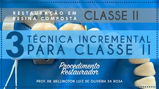 3 Técnica Incremental para Classe II [upl. by Amitarp809]