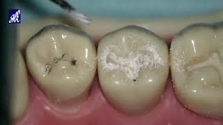 Class I Cavity Preparation Tooth 45 [upl. by Silrak352]