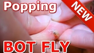 Popping bot fly  Bot fly removal  Botfly removal AAHC [upl. by Valerian43]