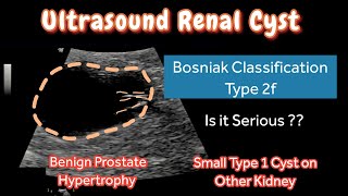 Renal Cyst Type 2f Bosniak Classification  Ultrasound  other Kidney Type 1 Small Cyst  Treatment [upl. by Estella]