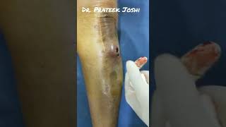 Incision and Drainage of Hematoma  Dr Prateek Joshi [upl. by Lairbag]