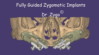 Fully Guided Zygomatic Implants [upl. by Pinto]