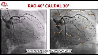 Coronary angiography standard views [upl. by Tonina40]