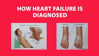 How Heart Failure is Diagnosed [upl. by Borries782]