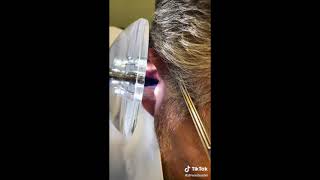 Ear Cleanings with quotDr Wax Busterquot [upl. by Sowell595]