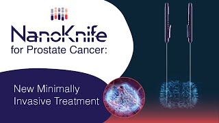 Nanoknife for Prostate Cancer New Minimally Invasive Treatment [upl. by Scarito]