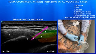 Ultrasound Guided Scapulothoracic Bursa Injection by probeultrasound [upl. by Reagan177]