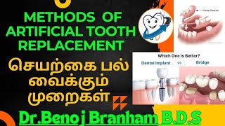 பல் கட்டுதல்  தமிழ் Methods of artificial tooth placement [upl. by Emia]