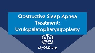 Obstructive Sleep Apnea Treatment Uvulopalatopharyngoplasty [upl. by Sugihara366]