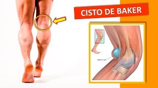 Cisto de Baker Exercício Alívio Dor Atrás do Joelho  Clínica de Fisioterapia Dr Robson Sitta [upl. by Vincelette283]