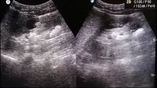 KIDNEY STONES  show multiple calculi  ultrasound usg stone kidney calculi [upl. by Misa198]