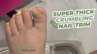 SUPER THICK Crumbling Nail Trim [upl. by Weibel]