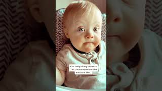 👶A Miracle Baby With Extra 21st Chromosome downsyndrome downsyndromeawareness [upl. by Ddej]