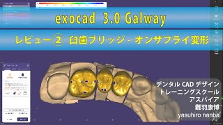 exocad 30 Galway レビュー ② 臼歯ブリッジオンザフライ変形 [upl. by Iarahs]