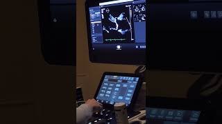 Heart Echo Ultrasound echocardiogram in Progress 120823 [upl. by Albin]