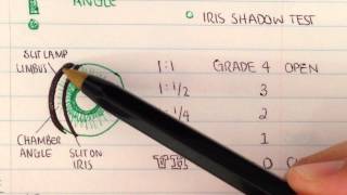 Gonioscopy Anterior chamber assessment [upl. by Gigi]