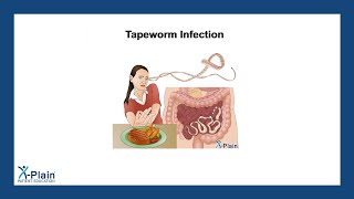 Tapeworm Infection [upl. by Derrek]