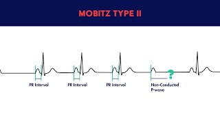 Second Degree Heart Block  Mobitz Type II [upl. by Orwin823]