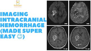 Brain Hemorrhage CT  MRI Made Super Easy  Radiology Video Tutorial [upl. by Zolner]