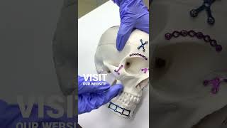 ColorCoded Maxillofacial Implants Precision for Trauma Care [upl. by Gardie]