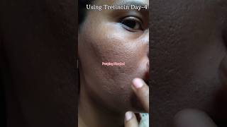 Using Tretinoin 0025 cream Day4 skincare viralvideo youtubeshorts shorts [upl. by Nafets]