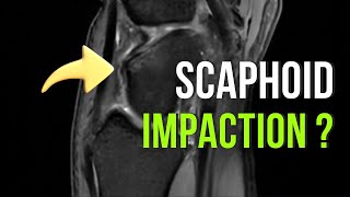 Scaphoid Impaction Syndrome vs Osteoid Osteoma of Scaphoid on MRI [upl. by Arika894]