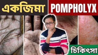 Dyshidrotic eczema  Pompholyx  চিকিৎসা  Dr Supratim Saha [upl. by Zorina62]