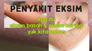 Dermatitis atopikeksim peradangan pada kulit menyebabkan rasa gatal yang hebat [upl. by Anerda738]