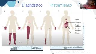 Complicaciones micro y macro vasculares de la DM2 [upl. by Hawger]