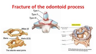 Fracture of the dens Odontoid process Classification clinical features amp treatment [upl. by Jeremie]