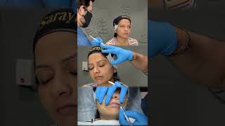 NonSurgical Facial sculpting Magic  Sarayu Clinics skincare [upl. by Neehsar]