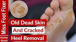 OLD DRY SKIN AND CRACKED HEEL REMOVAL BY MISS FOOT FIXER [upl. by Girish]