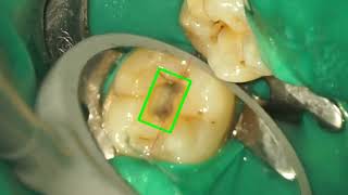 Mandibular second molar access open [upl. by Ahtrim945]