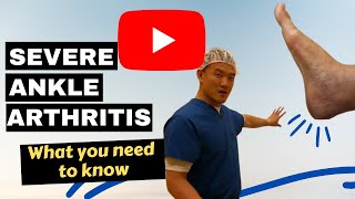 What you need to know about severe ankle arthritis  Florida Podiatrist [upl. by Amity]