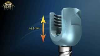 Columna  Sistema transpedicular con barra dinamica Suizo en Mexico parte2 [upl. by Campball]