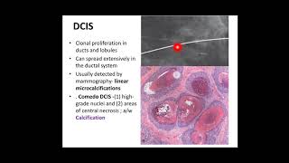 BREAST PATHOLOGY continued EPITHELIAL PROLIFERATIONS for medical undergraduates Robbins [upl. by Leay]