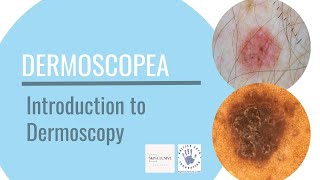 Introduction to Dermoscopy [upl. by Immij787]