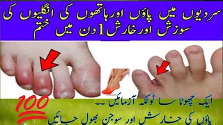 Feet Swelling Treatment Paon ki Sojan Ka ilaj  Chilblains treatment at home  Home Remedies [upl. by Adnamma]