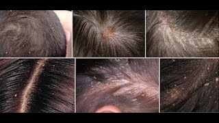 Oxygen Jet Peel Scalp  A complete skin rejuvenation treatment for smooth and refreshed scalp [upl. by Josselyn570]