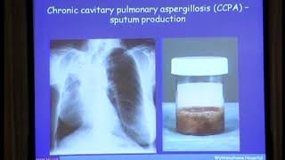 Chronic pulmonary aspergillosis [upl. by Head]