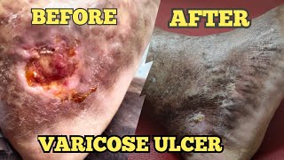 Ayurvedic Management of Varicose Ulcer Single case study [upl. by Katrinka774]